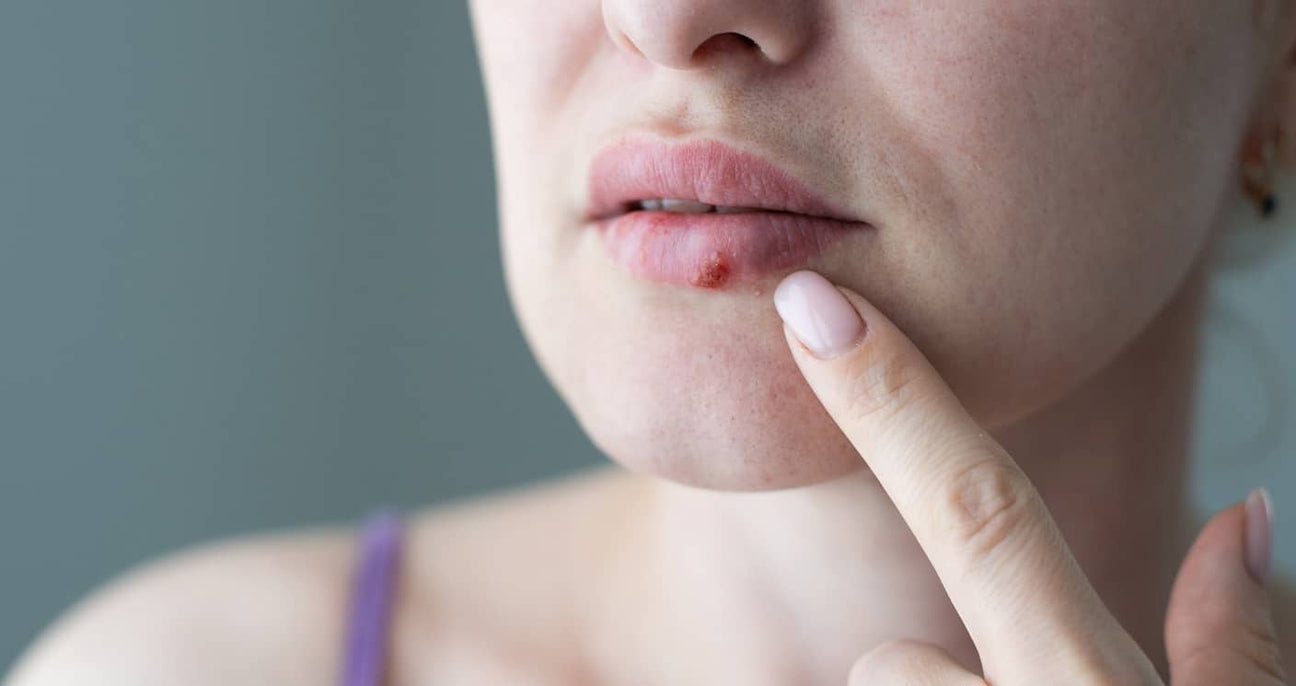 What Causes Cold Sores and How to Treat Them?