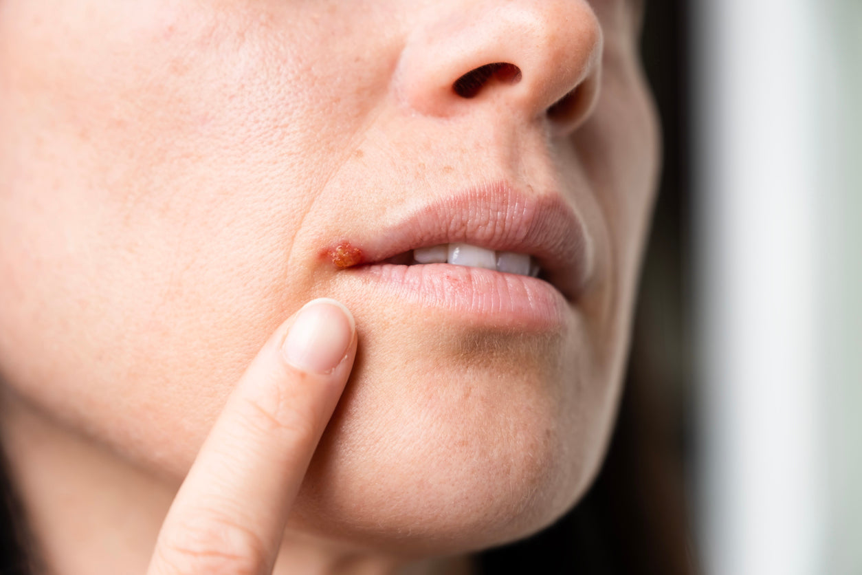 Year-Round Cold Sore Care: Protect, Relieve, and Heal